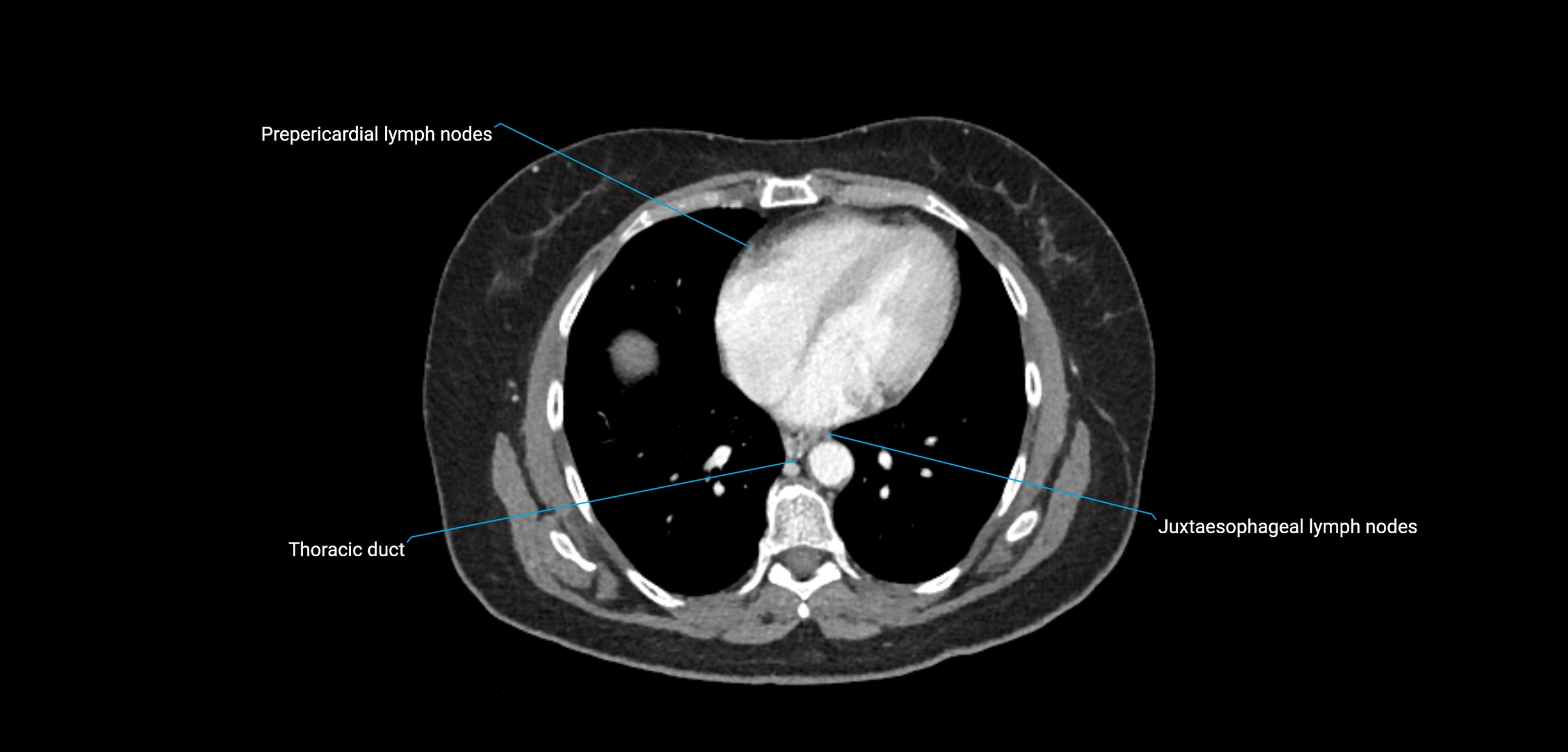 CT ct abdominal lymph nodes  axial cross sectional anatomy  enchanced radiology image -img-00002-00043.webp